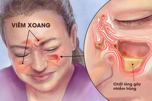 Dấu hiệu viêm xoang và phương pháp điều trị